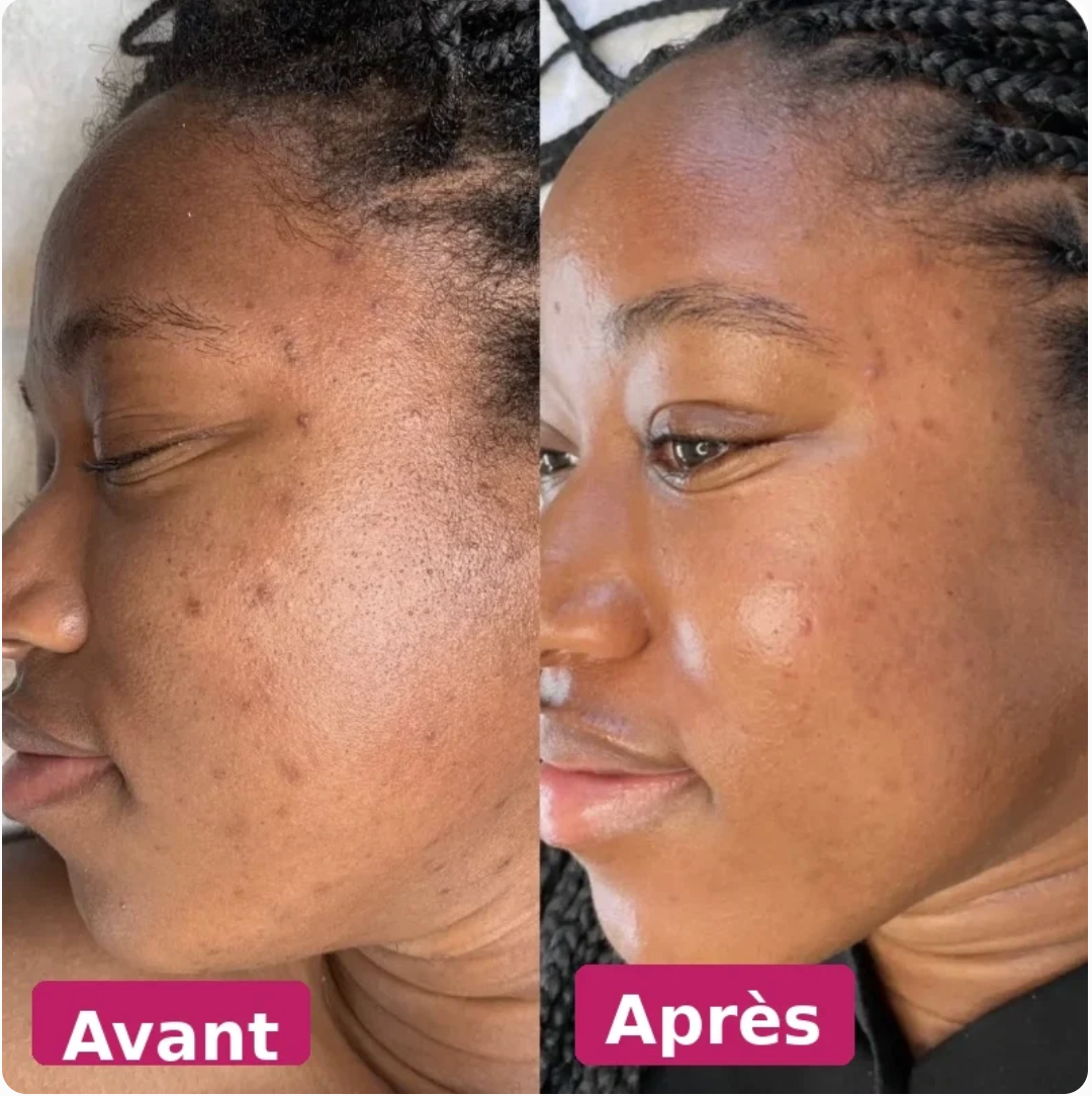 Crème anti taches — Taches estompées. Teint unifié. Éclat retrouvé